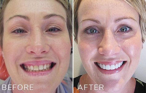 Porcelain Veneers Before & After Results : Glamsmile Porcelain Veneers Before And After, Veneers Before And After, Cosmetic Dentistry Procedures, Making Cosmetics, Porcelain Veneers, Dental Laboratory, Smile Makeover, Dental Cosmetics, Smile Design