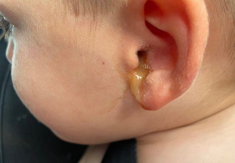 … Does Your Child Have Ear Drainage with Tubes? What It Is and When to Worry Read More » The post Does Your Child Have Ear Drainage with Tubes? What It Is and When to Worry appeared first on Just Simply Mom. How To Unstop Ears, Homemade Antibiotic, Ear Drainage, Fluid In Ears, Clogged Ears, Ear Tubes, Middle Ear, Lower Back Pain Exercises, Ear Drops