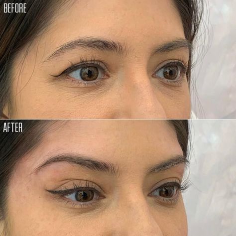 Botox Eyes, Beauty Surgery, Eye Lift Surgery, Brow Lift Surgery, Face Plastic Surgery, Botox Brow Lift, Pdo Threads, Botox Before And After, Botox Lips