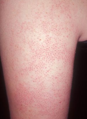 Nasty bumps on the back of your arms? Skin Bumps On Arms, Bumps On Legs, Bumps On Arms, Keratosis Pilaris Remedy, Patchy Skin, Nail Problems, Skin Bumps, Skin Care Guide, Keratosis Pilaris