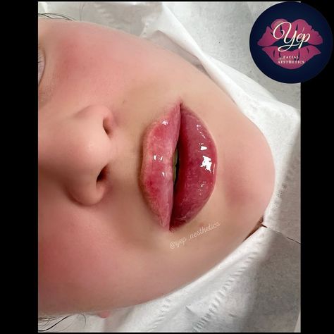 Yep Aesthetics on Instagram: “2ml in two sessions to create these gorgeous lips 👄 ✨ ➪➪ Swipe left to see more 😍💋 💌 𝗗𝗠 𝘁𝗼 𝗯𝗼𝗼𝗸! #lipfilleroffer #lipfillerenhancement…” Lip Filler With Cupids Bow, Defined Cupids Bow Lip Filler, Lip Filler 1 Ml, Lip Filler 0.5ml, .5ml Lip Filler, Lip Fillers, Lips, Beauty, Instagram