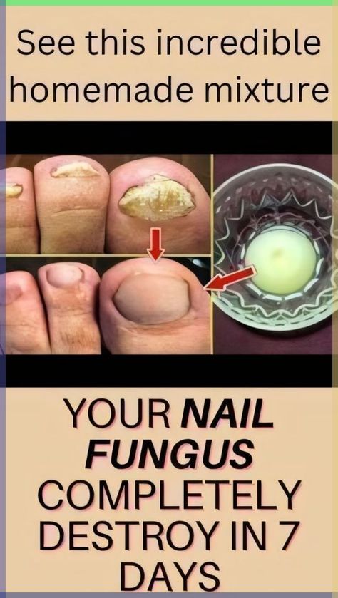 Discover effective methods to use hydrogen peroxide for treating nail fungus. Learn tips and techniques to restore healthy nails with this simple solution. Nail Infection, Nail Fungus Remedy, Coconut Oil Skin Care, Fungal Nail, Nails Today, Nail Care Routine, Brittle Nails, Coconut Oil For Skin, Toenail Fungus