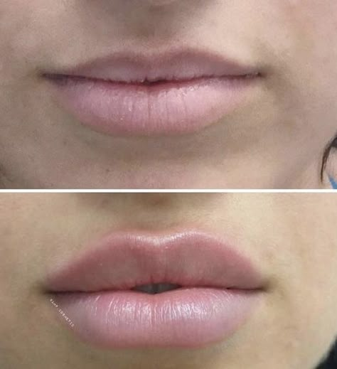 Dermal Fillers Lips, Lip Flip, Pdo Threads, Lips Inspiration, Face Fillers, Face Treatments, Facial Fillers, Facial Aesthetics, Lip Filler