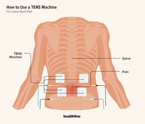 Tens Unit Placement Charts, Tens Electrode Placement, Back Spasm Relief, Tens Unit Placement, Pediatric Physical Therapy Activities, Back Spasm, Tens And Units, Lumbar Pain, Tens Machine