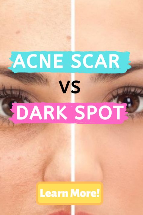 What is the difference between an acne scar and a dark spot? This is  one of our most frequently asked questions, and one of the biggest  misconceptions regarding post acne marks. #acne #acnescars #darkspots Pimples On Scalp, Cursed Doodles, Acne Scaring, Pimples Under The Skin, Post Inflammatory Hyperpigmentation, Bad Acne, Post Acne Marks, Pimples Remedies, Acne Skincare Routine