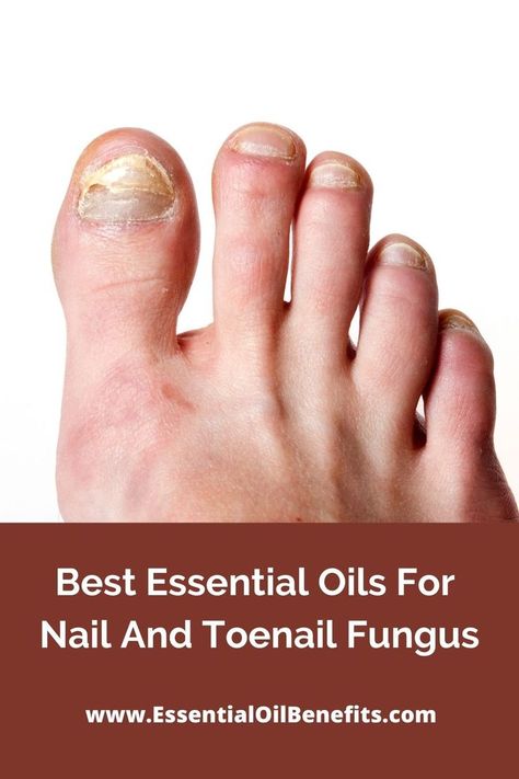 Best Essential Oils For Nail And Toenail Fungus Clove Oil Benefits, Toenail Fungus Essential Oils, Nail Remedies, Nail Care Diy, Fingernail Fungus, Antifungal Cream, Toenail Fungus Remedies, Nail Fungus Remedy, Essential Oils For Pain