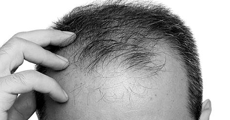 There are a lot of myths about hair loss. Here are some facts and myths to give you a better idea about hair loss. Hair Facts, Androgenetic Alopecia, Fue Hair Transplant, Best Hair Transplant, Male Pattern Baldness, Pattern Baldness, Home Remedies For Hair, Regrow Hair, Grow Hair Faster