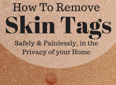 Skin Tags On Face, Burn Remedy, Remedies For Skin, Remove Skin Tags, Remove Skin Tags Naturally, Home Remedies For Skin, Tag Remover, Skin Care Routine For 20s, Skin Tags