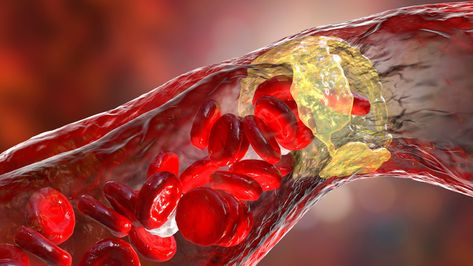 Key molecular pathway affecting atherosclerosis progression discovered Lowering Ldl, C Reactive Protein, Clogged Arteries, Hdl Cholesterol, Coronary Arteries, Ldl Cholesterol, Insulin Resistance, Cardiovascular Disease, Cholesterol Levels