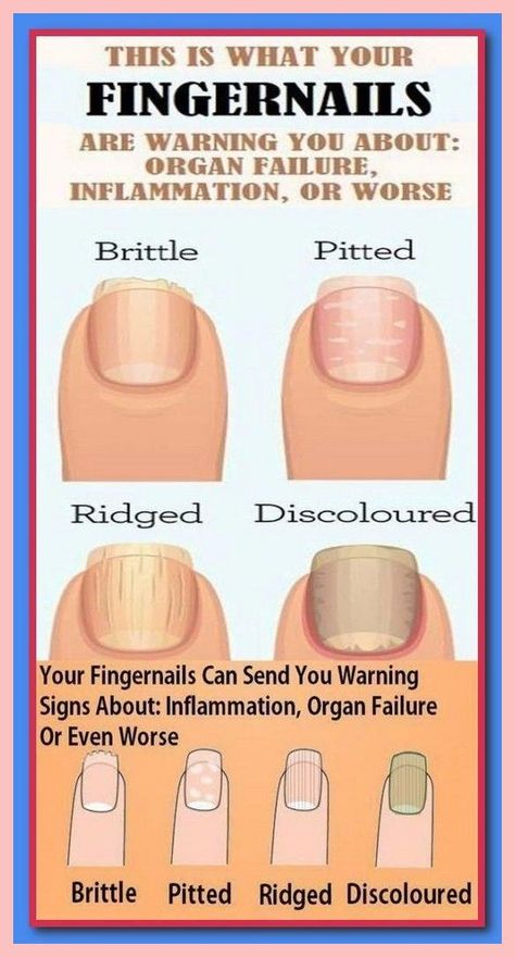 7 Health Warnings Signs Your Fingernails May Be Sending - NW Healthy Fingernails, Nail Health Tips, Split Nails, Nails And Health, Nail Conditions, Homemade Medicine, Home Made Remedies, Women Health Tips, Exercise To Reduce Thighs