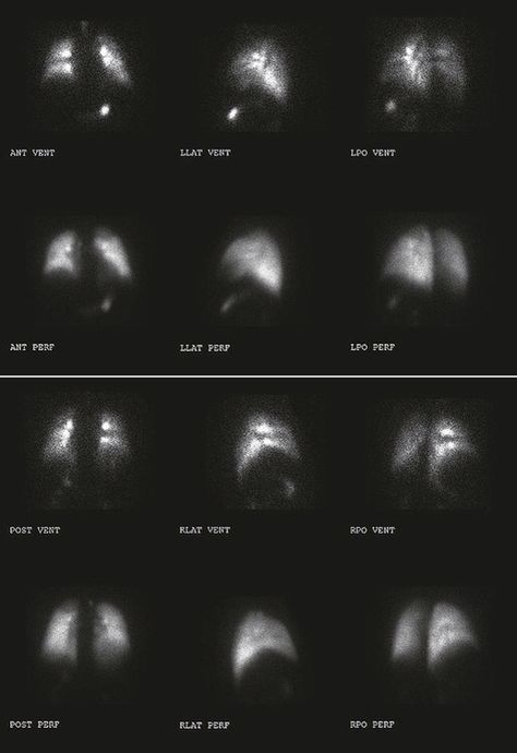 Nuclear Medicine lung study. Nuclear Medicine Aesthetic, Nuclear Medicine Technologist Aesthetic, Nuclear Medicine Technologist, Pet Ct, Nuclear Medicine, Radiology, Homework, Anatomy, Vision Board