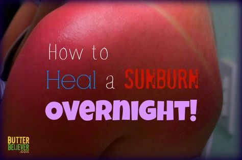 How to Heal a Sunburn Overnight with Two Simple Ingredients - I have used this to great success but we rarely get burned using coconut oil as sun protection. Heal Sunburn, Sickness Remedies, Burn Relief, Sunburn Remedies, Diy Medicine, Sunburn Relief, Sun Safety, Diy Remedies, Beach Please