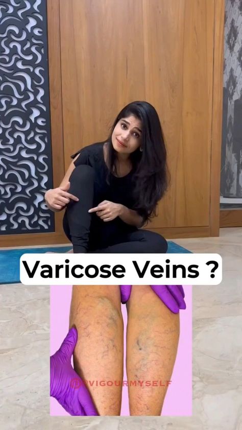 Exercises To Improve Leg Circulation, Improve Circulation Naturally, How To Improve Leg Circulation, Exercises For Varicose Veins, Circulation In Legs Improve, Varicose Vein Remedy Natural Treatments, Vericous Veins Exercises, Vericose Veins Pregnant, Leg Massage For Circulation