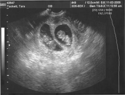 5 Week Ultrasound Pictures, Twin Ultrasound Pictures 8 Weeks, Twins Ultrasound, 3 Weeks Pregnant Ultrasound Twins, 2weeks Pregnant Ultrasound, 8weeks Pregnant Ultrasound, 10 Weeks Pregnant, 6weeks Pregnant Ultrasound, 4d Ultrasound