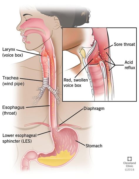 Post Nasal Drip Remedy Sore Throat, Drip Pictures, Lpr Diet, Dysphagia Therapy, Silent Reflux, Reflux Recipes, Reflux Remedies, Body Facts, Throat Remedies