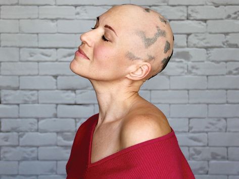 Alopecia Awareness Tattoo, Bald Women Aesthetic, Alopecia Bandana, Women With Alopecia, Alopecia Awareness Shirts, Androgenic Alopecia In Women, Scarring Alopecia, Alopecia Headwear, Pregnancy Hairstyles