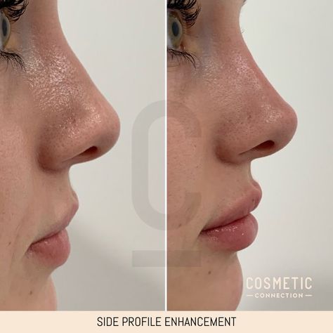 Lip Filler Before And After Side Profile, Profile Balancing Fillers, Lip Fillers Side Profile, Nose Tip Filler, Best Nose Shape, Lip Filler Side Profile, Subtle Nose Job, High Nose Bridge Side Profile, Perfect Nose Side Profile