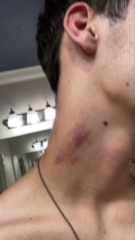 Places To Give Hickey, Hickey On Boy, Hickies Neck Snapchat, Head Scratches Boyfriend, Neck Bite Mark, Guy With Scratch On Back, Hickey Neck Aesthetique, Love Bite Snap, Love Bites Hickey