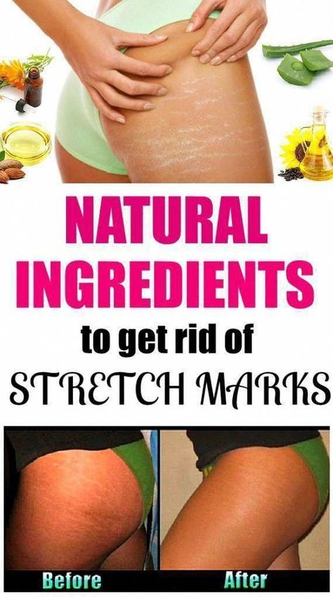 Stretch Mark Remedies, Stretch Mark Cream, Baking Soda Shampoo, Stretch Mark, Skin Care Acne, Aging Skin Care, Nashville Tn, Anti Aging Skin Care, Skin Health