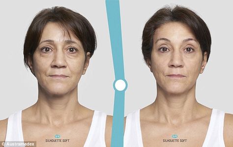 I HAD A THREAD LIFT - THIS IS WHAT HAPPENED - Thread Lift Face, Facelift Surgery, Facelift Procedure, Anti Wrinkle Injections, Face Lift Surgery, Thread Lift, Subcutaneous Tissue, Problem Skin, Neck Lift