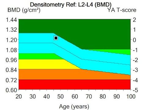 Is the new, emerging REMS bone density test right for you? See how it compares to the DEXA here. Bone Density Test, Radiation Exposure, Bone Density, Strength Training Workouts, Body Composition, At Home Exercises, Bone Health, Fitness Coach, Clinical Trials