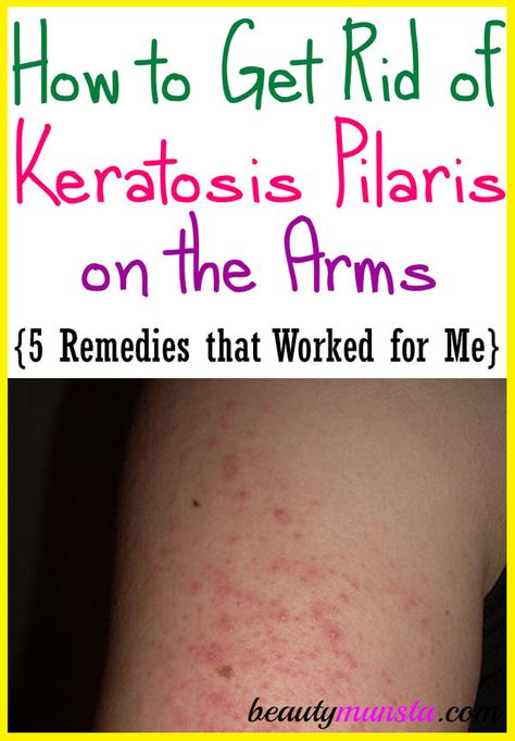 I know how to get rid of keratosis pilaris on arms naturally because I had it and now I don’t! Keratosis Pilaris on Arms When I was a kid, I had terrible keratosis pilaris on my arms and I didn’t even know what it was! It never bothered me until I got made fun of … Arm Acne, Bumps On Arms, Natural Beauty Hacks, Strawberry Skin, Dru Hill, Regular Skin Care Routine, Heat Rash, Keratosis Pilaris, Bumpy Skin