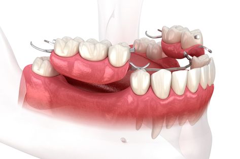 dentures near you Prosthetic Teeth, Denture Cleaner, Snap On Smile, Teeth Covers, Temporary Tooth, Columbia Maryland, Tooth Repair, Bone Grafting, Partial Dentures