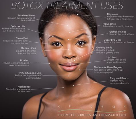 Botox, Dysport, Jeuveau, Xeomin - Chicago Cosmetic Surgery and Dermatology Botox Injection Sites, Facial Esthetics, Facial Injections, Botox Before And After, Eyebrow Lift, Botox Cosmetic, Botox Face, Facial Fillers, Cosmetic Injectables