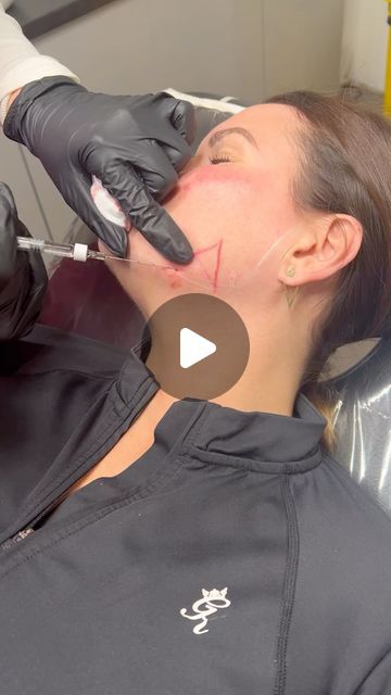 Cassie’s Cosmetics & Training Academy on Instagram: "🄼🄾🄳🄴🄻 🄲🄰🄻🄻.....📣  Snatched Package 5ml filler  Jawline ✔️ cheeks ✔️ chin ✔️ chin dips ✔️ naso folds or lips ✔️ £250!!!!   ( RUNNING FOR 1 WEEK ONLY! Offer ends Monday 12th August T&Cs apply )   Pls DM us to book ✨ .. .. .. .. 📍Wickford Essex  ⭐️CPD training Academy  💜Aesthetics PMU Beauty Slimming  🖤Advanced aesthetics practitioner  🆘Complications Trained   .. .. .. ..  #contourwithfillers#snatchedjawline#facialinjections#slimdownyourface#hyaronicacid#skinrejuvenation#cheekfiller#chinfillers#essexsalon#wickfordaestheticstraining#ukaestheticclinic#advancedaedtheticscenter" Aesthetics Practitioner, Jawline Filler, Chin Filler, Cheek Fillers, Chin Chin, Training Academy, Model Call, Instagram Model, Lips