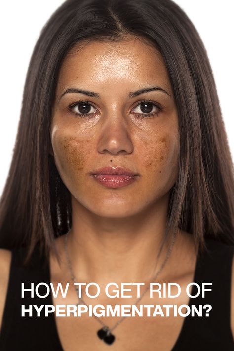 It is natural to feel frustrated when dark spots on your face do not fade away with time. Cheer up! Numerous clinical research studies have claimed that the use of topical ingredients like glycolic acid, vitamin C, and niacinamide is quite effective in the treatment of hyperpigmentation. Black Pigmentation On Face, Black Spot On Face, Remove Hyperpigmentation On Face, Vitamins For Hyperpigmentation, Face Discoloration Remedies, How To Remove Hyperpigmentation On Face, Spots On Face Meaning, Skin Care Solutions Hyperpigmentation, Dark Pigmentation On Face