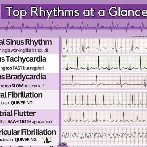 Respiratory Chad on Instagram: "Top Rhythms at a Glance🫀  #respiratory #respiratorytherapy #rrt" Nursing Cardiac, Ekg Nursing, Ekg Tech, Ekg Rhythms, Cardiac Sonography, Nurse Teaching, Cardiac Rhythms, Poster Format, Digital Notes