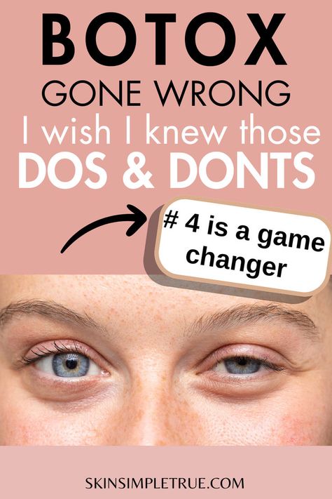 botox dos and donts for beginners Botox After Care, Botox For Migraine, Botox Eyes, Botox Under Eyes, Botox Aftercare, Botox Migraine, Botox Forehead, Botox Results, Botox Injection Sites