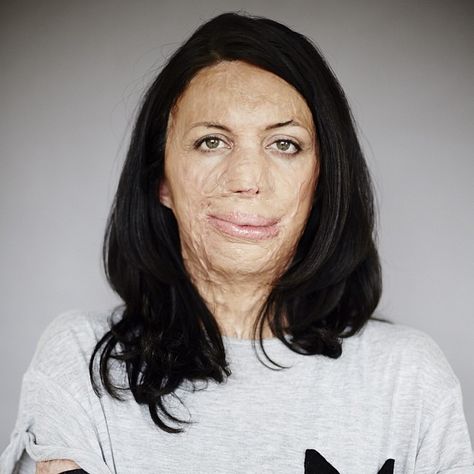 Burned Over 65 Percent of Her Body, Turia Pitt Shows Us What It Means to Persevere Face Burn, Burn Victims, Theatre Makeup, Popular Magazine, Dark Underarms, People Of Interest, Women Magazines, Cover Model, Social Change