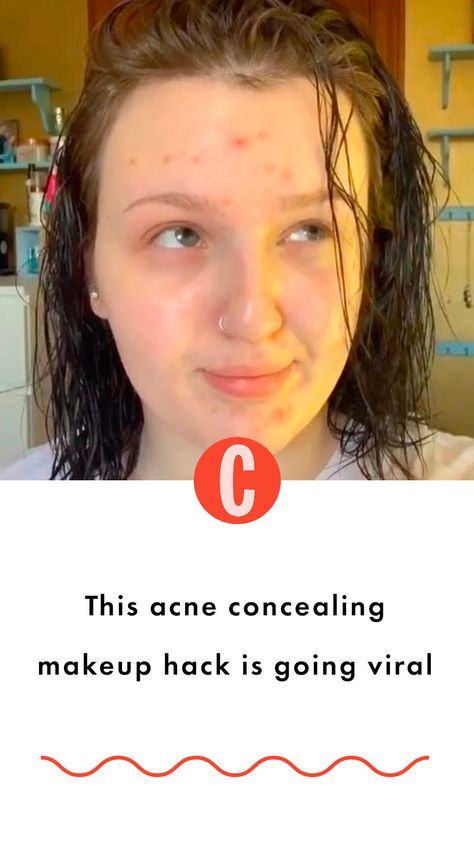 In her own words, makeup artist Mikayla says that by using her method, she's been able to "trick people" into thinking she "has no acne at all". Acne Breakout, Going Viral, Concealer Brush, Milk Makeup, Concealer, Makeup Tips, Makeup Artist, Beauty Makeup, Serum