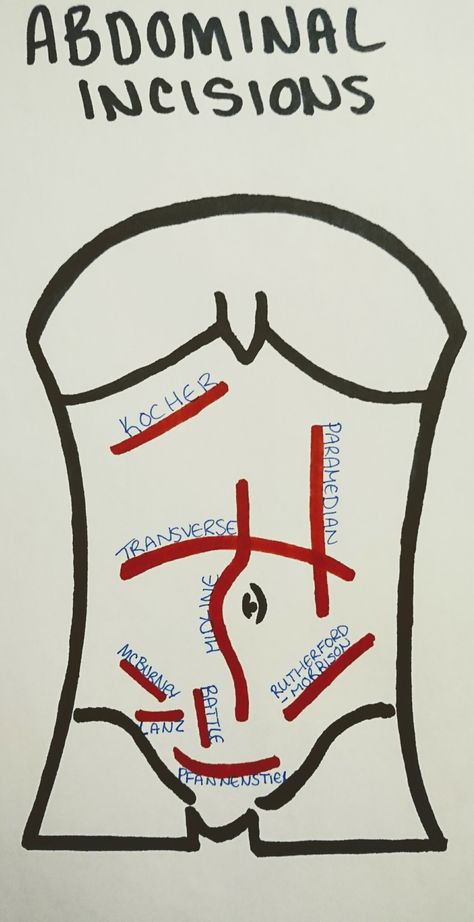 Abdominal incisions Abdominal Incisions, Surgical Incisions, Surgical Technologist Student, Surg Tech, Nursing Fun, Medical Mnemonics, Medicine Notes, Nursing Mnemonics, Surgical Nursing