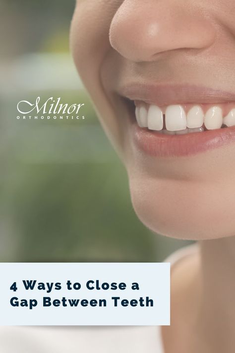 4 Ways to Close a Gap Between Teeth Tooth Gap Smile, Tooth Gap Aesthetic, Teeth Gaps Aesthetic, Gap Aesthetic, Gap Between Teeth, Tooth Gap, Space Between Teeth, Fix Teeth, Teeth Aesthetic