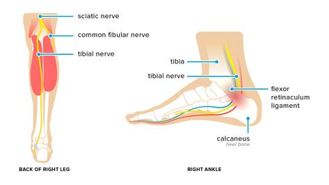 Tarsal Tunnel Syndrome: Symptoms, Causes, and Treatments Foot Pain Chart, Medical Consent Form Children, Tibial Nerve, Tarsal Tunnel, Nerve Conduction Study, Pain Chart, Health Notes, Nursing Cheat, Alphabet Code