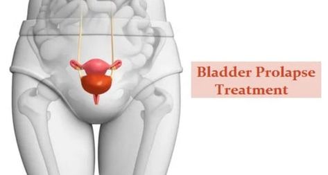 Heal Leaky Bladder or Bladder Prolapse Naturally and Safely – NeuEve Leaky Bladder Remedies, Bladder Leakage Remedies, Bladder Prolapse, Uterine Prolapse, Pelvic Bone, The Menstrual Cycle, Bladder Leakage, Muscle Atrophy, Pelvic Floor Muscles