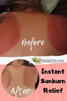 Sunburn On Face, Vinegar For Sunburn, Best For Sunburn, How To Help Sunburn, Essential Oil For Sunburn, Get Rid Of Sunburn, How To Treat Sunburn, Burn Remedy, Sunburn Peeling