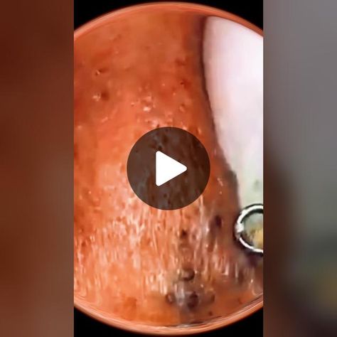 #squeeze #squeezeyuk #acne #pimple #pimlepop #blackhead #satisfying #f... | Satisfying Video | TikTok Satisfying Pore Cleaning Videos, Satisfying Acne Removal Videos, Pimple Removal Satisfying Videos, How To Pop A Pimple With A Q Tip, Squeezing Blackheads, Avoid Pimples Tips, Blackheads