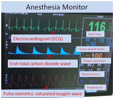 Anesthesia monitor with explanation of each component, and what it tells us about the patients vitals. Vet Tech Anesthesia Monitoring, Anesthesia Monitoring Vet Tech, Vet Anesthesia Monitoring, Veterinary Anesthesia Monitoring, Anesthesia Monitoring, Veterinary Technician Student, Veterinary Anesthesia, Bremerton Washington, Vet Tech School