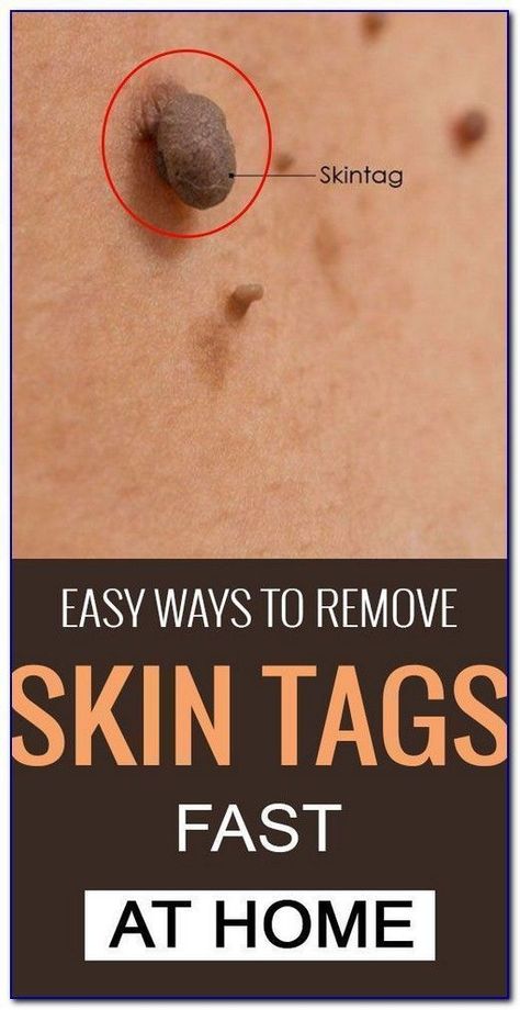 HOW TO REMOVE SKIN TAG IN 1 NIGHT Remove Skin Tags, Remove Skin Tags Naturally, Tag Remover, Get Rid Of Warts, Home Remedy For Cough, Skin Tags, Cold Sores Remedies, Natural Health Care, Natural Sleep Remedies