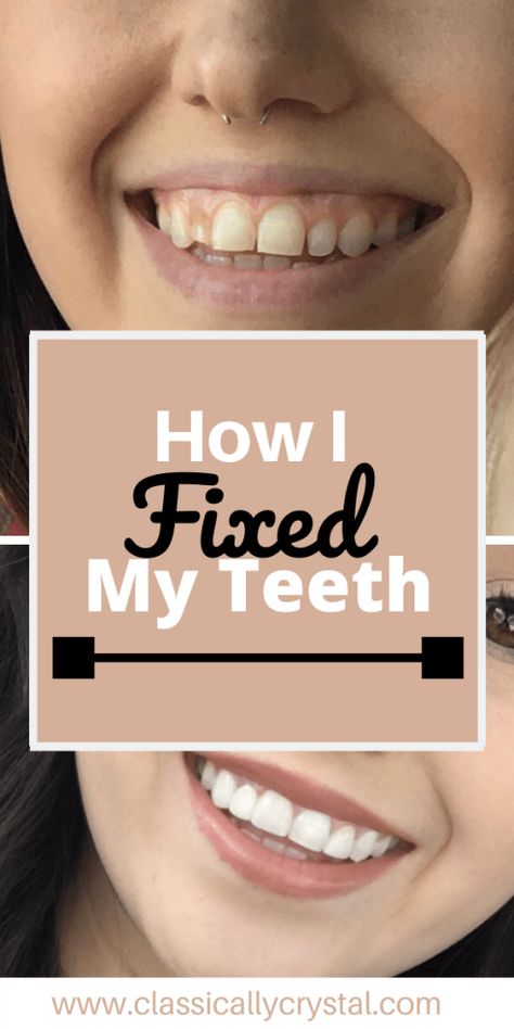 How to Fix Your Smile - Classically Crystal How To Have Perfect Teeth, Teeth Shape Perfect, How To Have Straight Teeth, How To Fix Your Smile, Nice Smile Teeth, How To Get Straight Teeth, How To Smile Without Showing Teeth, How To Have A Pretty Smile, Improve Smile