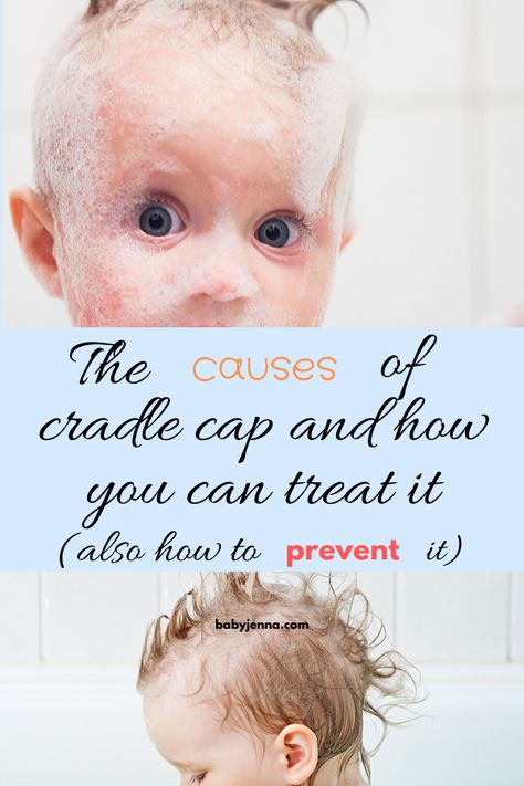 Natural Remedies For Cradle Cap, Natural Cradle Cap Remedy, How To Get Rid Of Cradle Cap, Toddler Cradle Cap, Cradle Cap Remedies, Baby Cradle Cap, Cradle Cap, Baby Cradle, Do Baby