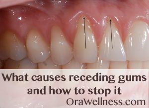 What causes receding gums and how to stop it - OraWellness Grow Back Receding Gums, Gum Recession, Teeth Whitening Remedies, Teeth Health, Stronger Teeth, Receding Gums, Gum Care, Oil Pulling, Gum Health