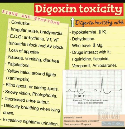 Digitalis toxicity Digoxin Toxicity, Cardiovascular Nursing, Nursing Cheat, Lpn Schools, Nursing Mnemonics, Medical Surgical Nursing, Cardiac Nursing, Pharmacology Nursing, Nursing School Survival