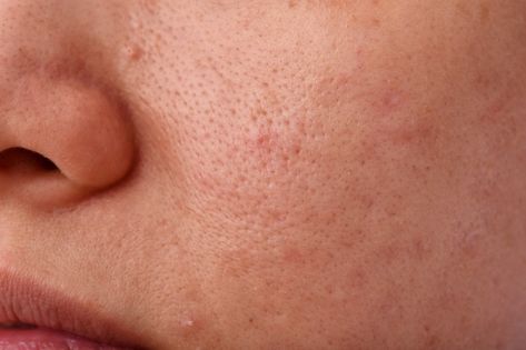 Skin problem with acne diseases, close u... | Premium Photo #Freepik #photo #medical #face #mouth #oil Greasy Face, Big Pores, Open Pores, Skin Photo, Skin Structure, Skin Specialist, Skin Disorders, Skin Clinic, How To Get Rid Of Acne