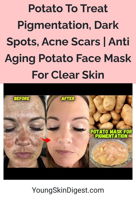 Potato To Treat Pigmentation, Dark Spots, Acne Scars | Anti Aging Potato Face Mask For Clear Skin Baking Soda Face Mask Dark Spots, Potato Face Mask, Potato Face, Natural Anti Aging Skin Care, Potato Skin, Young Skin, Diy Remedies, Skin Care Solutions, Dark Spots