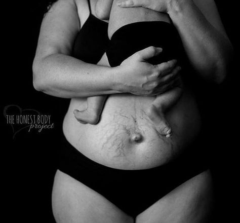 #Mothers celebrate their #postbaby bodies to spread an #inspirational msg http://bit.ly/1FWuz1v  @thehonestbodies Body Positive Photography, Post Pregnancy Body, Strech Marks, Mom Body, Pregnancy Body, Postpartum Belly, Post Baby Body, Mom Bod, Postpartum Body