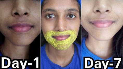 Pin on Emilio Garay Pigmentation Removal Remedies, Face Darkness Removal, Dark Pigmentation Remedies, How To Remove Dark Patches On Face, Around Mouth Darkness, Remove Hyperpigmentation Around Mouth, Pigmentation Around Mouth Remedies, How To Remove Pigmentation Around Mouth, How To Remove Pigmentation